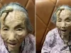 Idosa chinesa de 107 anos desperta atenção por ‘chifre’ crescendo na testa